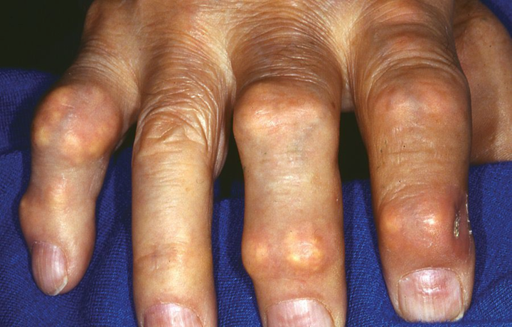 enlarged joints on fingers